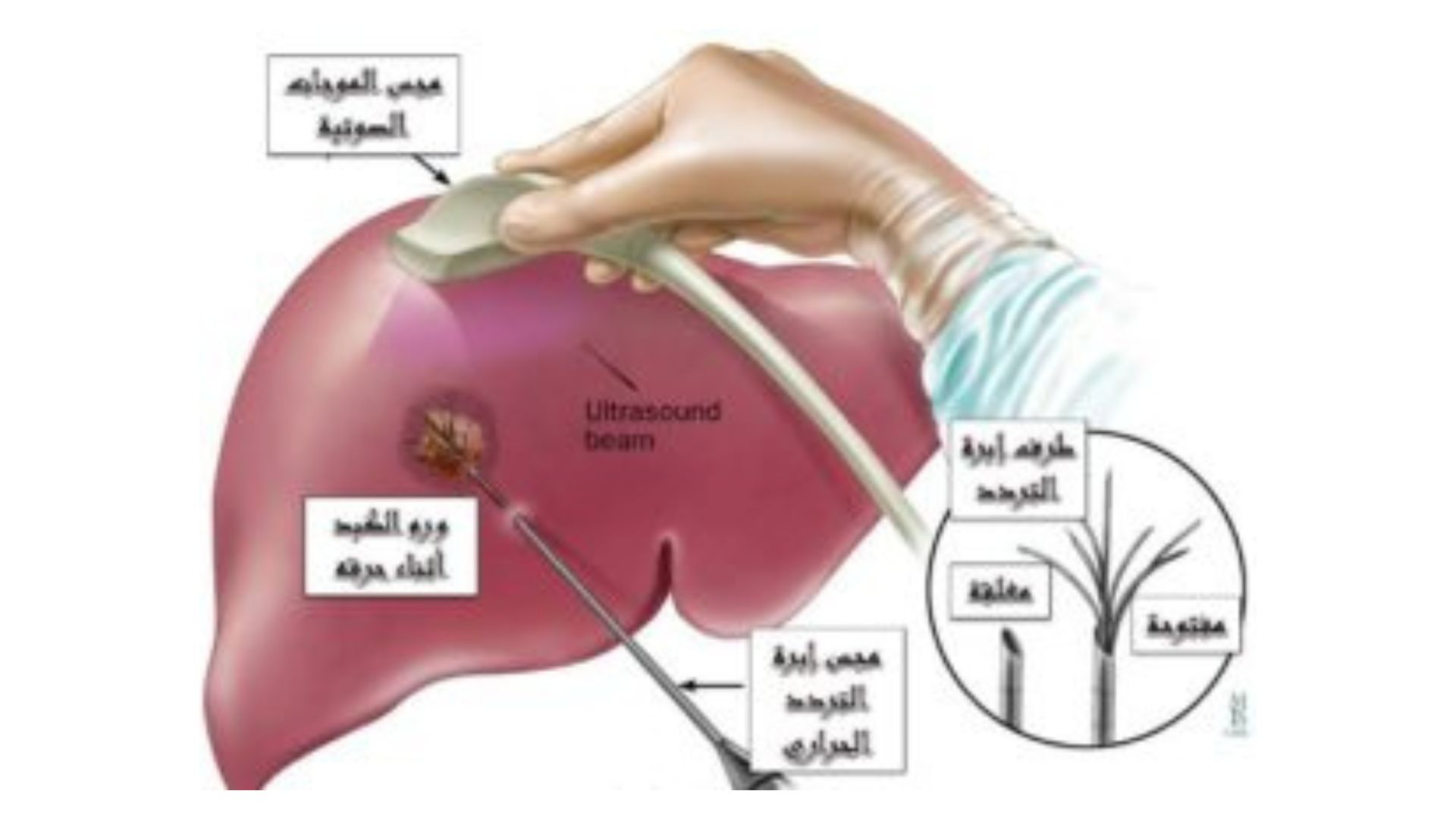 أفضل دكتور أشعة تداخلية في مصر | الأشعة التداخلية | مركز الأشعة التداخلية علاج بدون ألم، وبدون آثار جراحية، وشفاء سريع ومضمون. بديل الجراحة